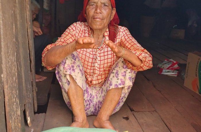 Bệnh nhân phong phải chịu nhiều nỗi đau với những đôi tay không ngón