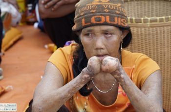 Với đôi bàn tay không ngón, bệnh nhân phong rất cần được giúp đỡ những nhu yếu phẩm, thuốc men